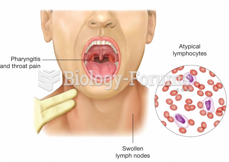 Mononucleosis is caused by the Epstein–Barr virus. Symptoms of the infectious disease are swollen pa