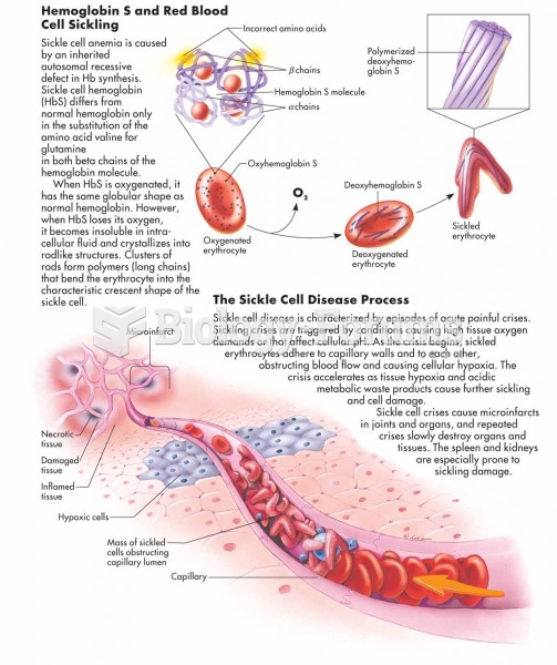 Sickle cell anemia. The clinical manifestations of sickle cell anemia result from pathologic changes