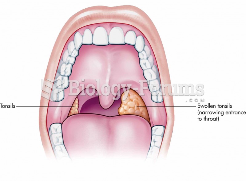 Tonsils—normal and enlarged.