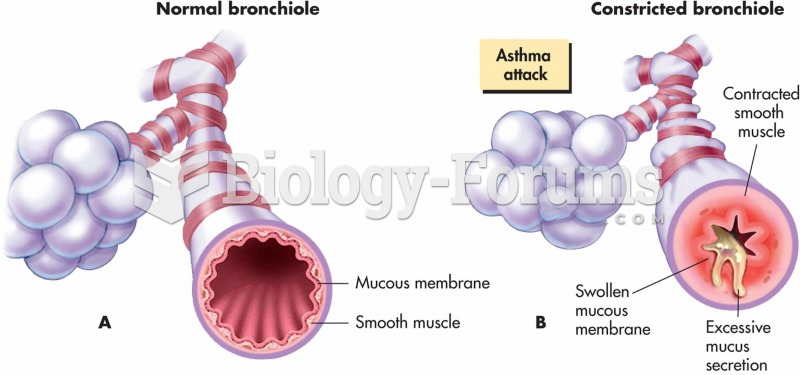 Changes in bronchioles during an asthma attack: (A) normal bronchiole and (B) in asthma attack.