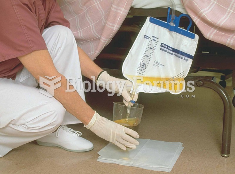 Closed urinary drainage system. Urine being measured after it leaves patient’s body via catheter.