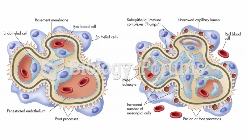 Normal glomerulus.  Acute glomerulonephritis.