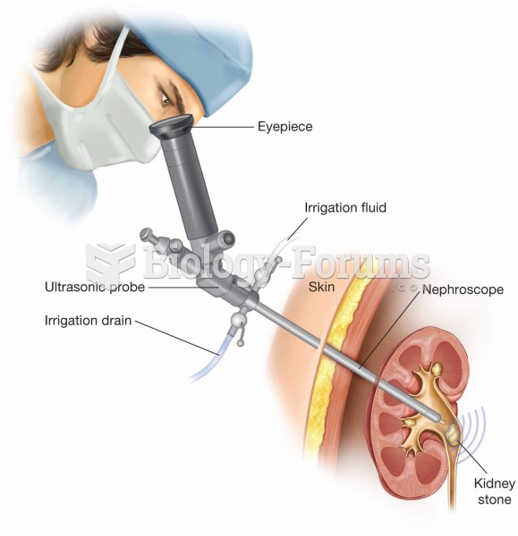Percutaneous ultrasonic lithotripsy. A nephroscope is inserted into the renal pelvis, and ultrasound
