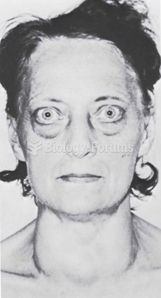 Patient with exophthalmos.