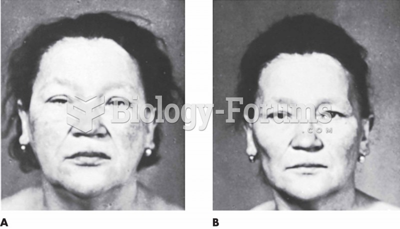 (A) A 62-year-old patient with myxedema exhibiting marked edema of the face and a somnolent look. Th