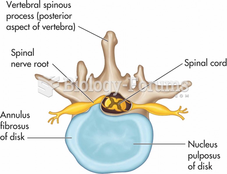Herniated intervertebral disk: the herniated nucleus pulposus is applying pressure