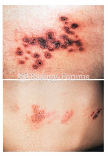 Examples of herpes zoster. 