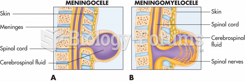 Congenital abnormalities of the spine. A. Meningocele. B. Meningomyelocele.