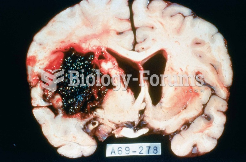 Cross-section of brain showing cerebrovascular accident.