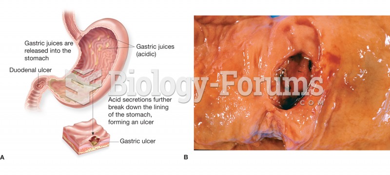 (A) Figure illustrating the location and appearance of a peptic ulcer in both the stomach and the du