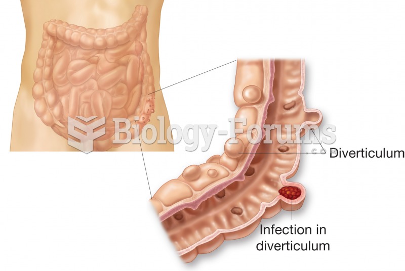 Diverticulosis. Figure illustrates external and internal appearance of diverticula. 