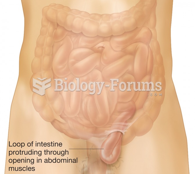 An inguinal hernia. A portion of the small intestine is protruding through the abdominal muscles int