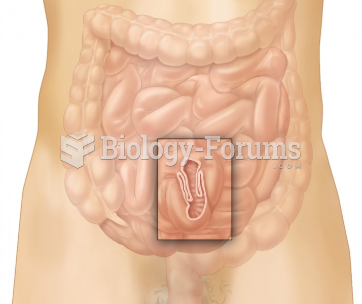 Intussusception. A short length of small intestine has telescoped into itself. 