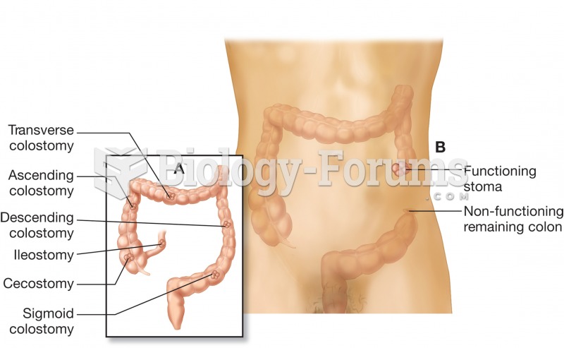 (A) The colon illustrating various ostomy sites; (B) colostomy in the descending colon, illustrating