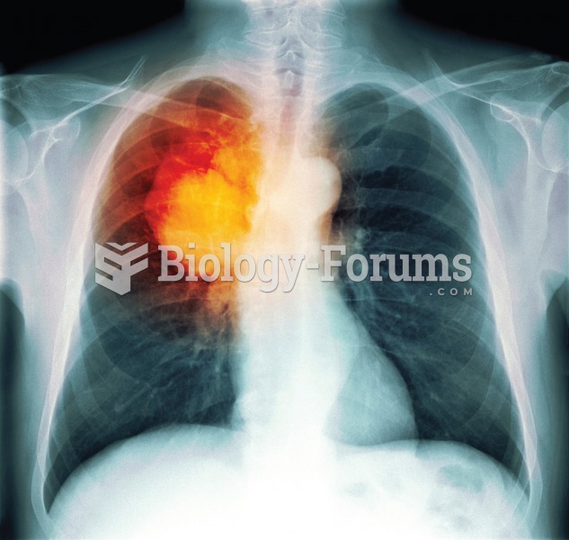 Color enhanced X ray of large malignant tumor in the right lung. 