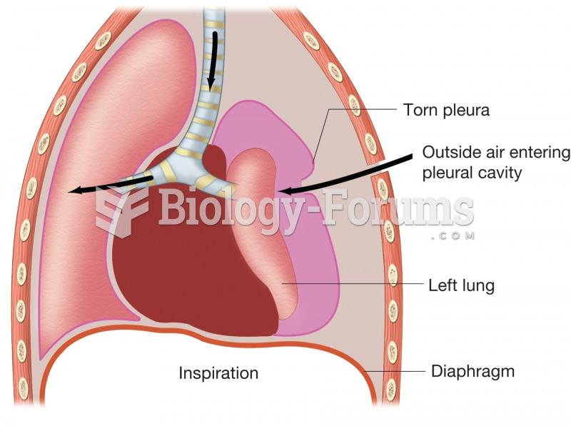 Pneumothorax. Figure illustrates how puncture of thoracic wall and tearing of pleural membrane allow