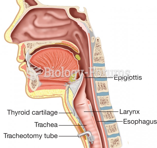 A tracheotomy tube in place, inserted through an opening in the front of the neck and anchored withi