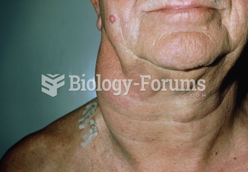 Photo of the neck of a patient with non-Hodgkin’s lymphoma showing the swelling associated with enla