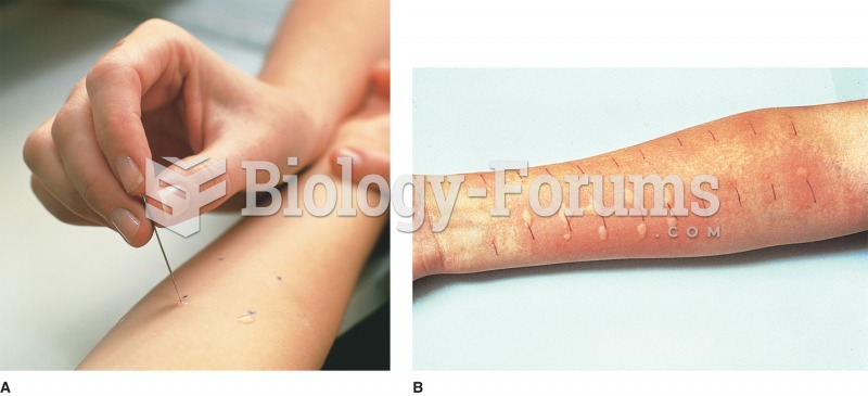 (A) Scratch test; patient is exposed to allergens through a light scratch on the skin; (B) Positive 