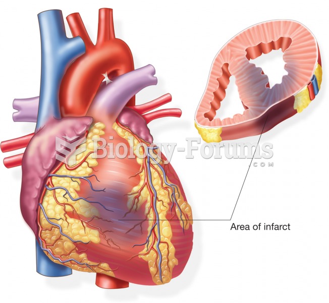 External and cross-sectional view of an infarct caused by a myocardial infarction. 