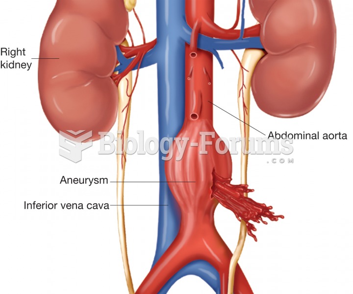 Illustration of a large aneurysm in the abdominal aorta that has ruptured. 