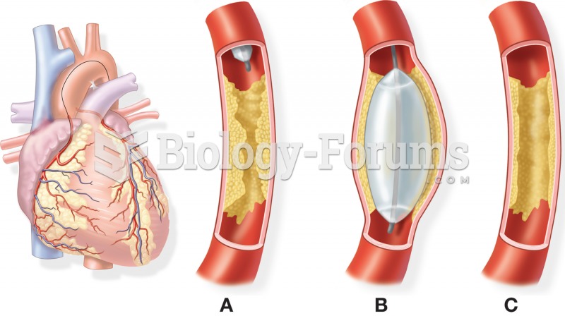 Balloon angioplasty: (A) deflated balloon catheter is approaching an atherosclerotic plaque; (B) pla