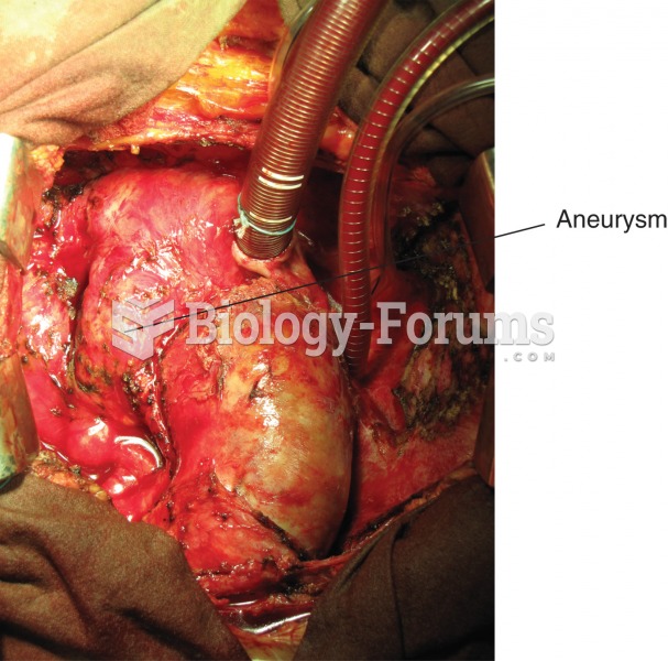 Aneurysm. Photograph of the aorta, the large blood vessel arising from the heart, with a large bulge