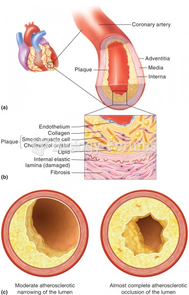 Atherosclerosis. (a) A sectioned coronary artery that exhibits an accumulation of fatty plaque, whic