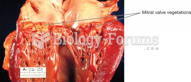 Endocarditis. The human heart has been sectioned to reveal the left ventricle and origin of the aort