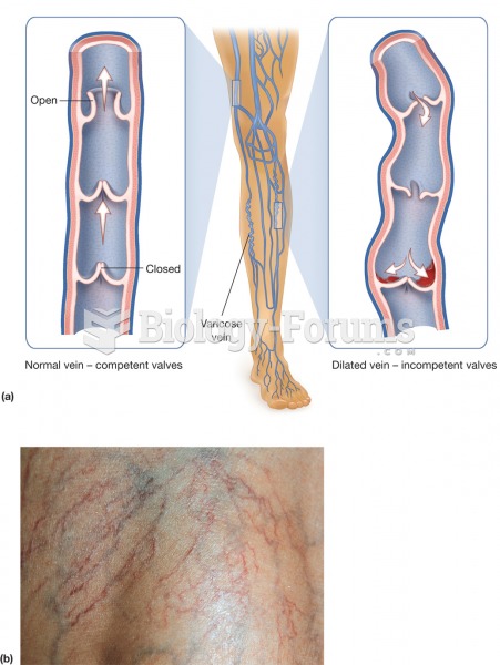 Varicosis. (a) Varicose veins develop due to the failure of valves in the superficial veins of the l