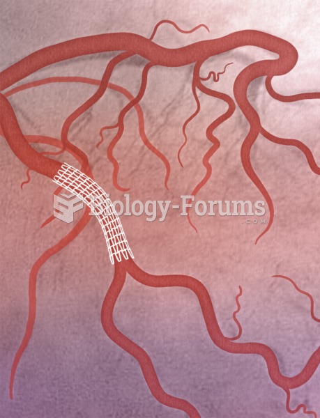 Coronary stent. Illustration of an angiogram revealing a coronary stent, which helps prevent closure
