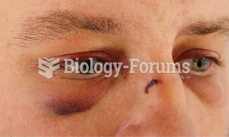 Hematoma. A hematoma around the right eye caused by an injury. A hematoma is the result of bleeding 