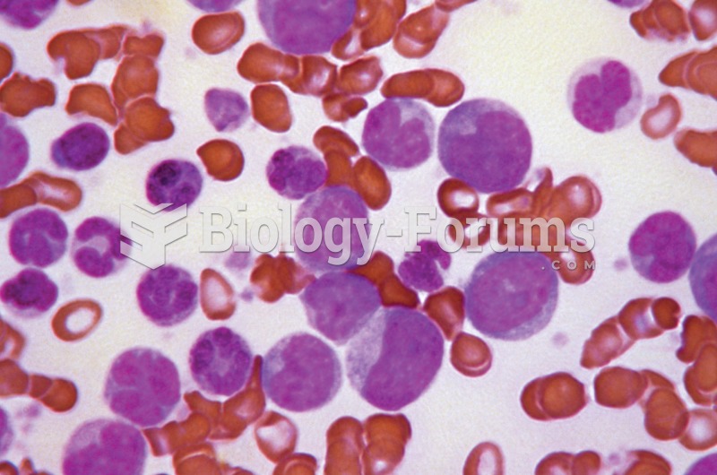 Leukemia. A blood smear from a patient suffering from leukemia demonstrates the abundance of enlarge