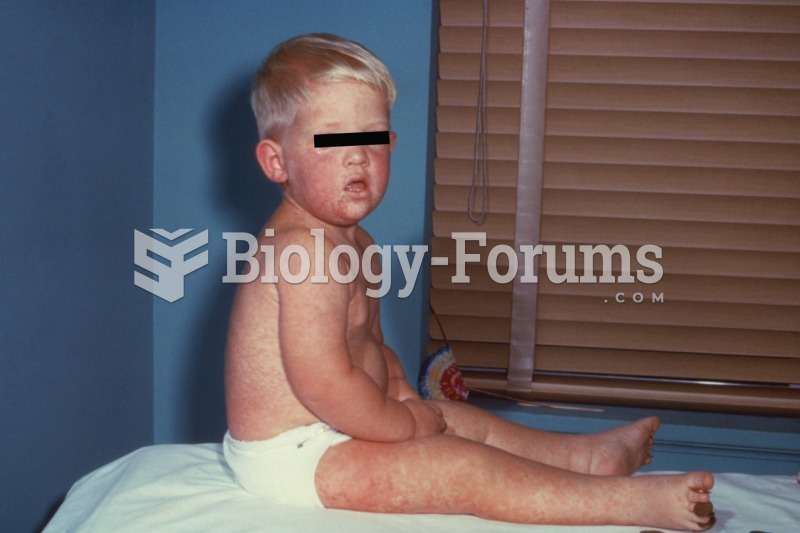 Measles. A photograph of a child stricken with measles, showing the tell-tale sign of the skin rash.