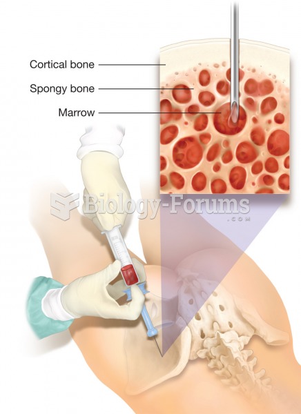 Bone marrow transplant. A bone marrow transplant is usually extracted from red bone marrow within a 