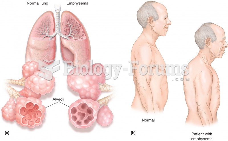 Emphysema. (a) Illustration comparing normal lungs and emphysemic lungs. The inserts illustrate how 