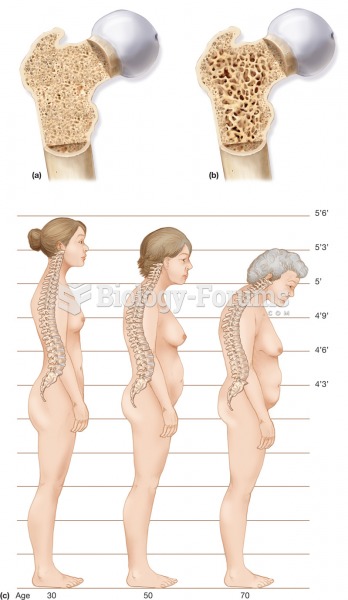 Osteoporosis. (a) A section through normal spongy bone. (b) A section through a bone with osteoporos