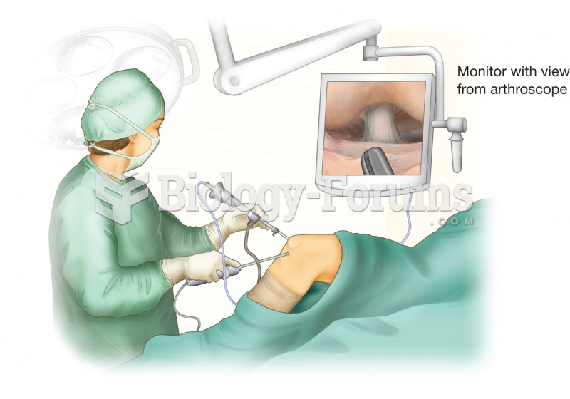 Arthroscopic surgery. In this illustration, the knee joint is undergoing surgery with a specialized 