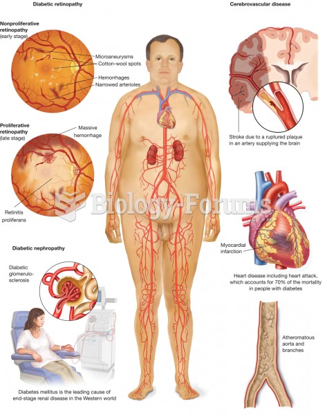 Diabetes mellitus. The metabolic disease diabetes mellitus, with symptoms of polydipsia, polyuria, a