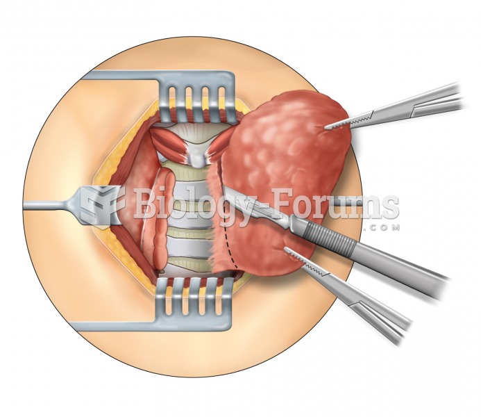 Thyroidectomy. In this procedure, the thyroid gland is accessed by a vertical incision through the n