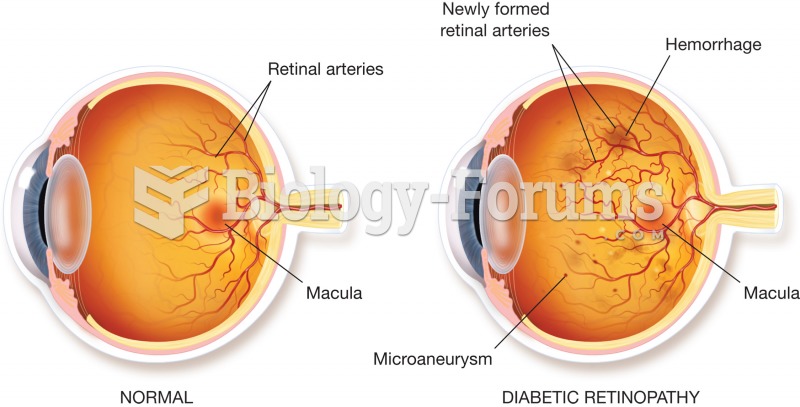 Retinopathy. Illustration of a normal retina (left) and a diseased retina (right). The diseased reti