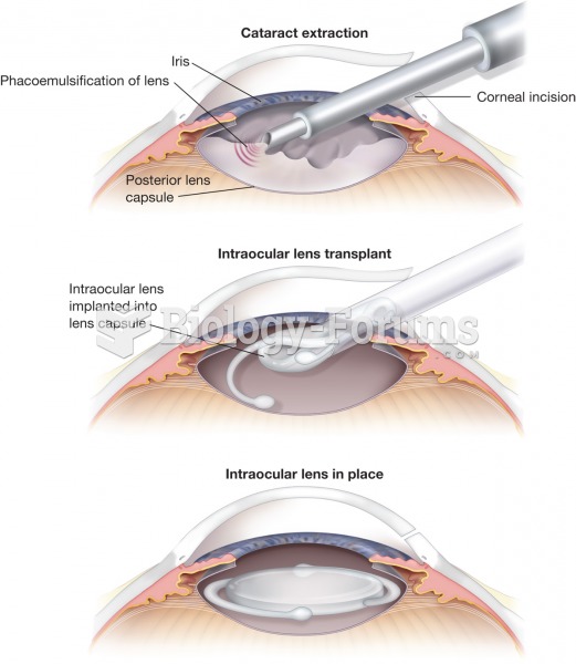 Cataract extraction. The procedure involves a surgical removal of a cataract lens and its replacemen