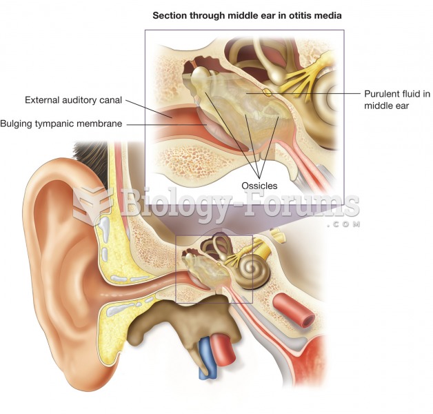 Otitis media. This illustration shows an inflamed tympanic cavity, which is the most common source o