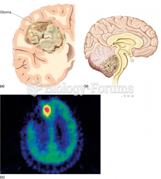 Glioma. (a) Illustration of a large glioma (colored area) within the left cerebral hemisphere in a s