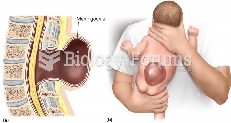 Meningocele. (a) A meningocele is a herniation of the meninges, usually associated with the spinal c