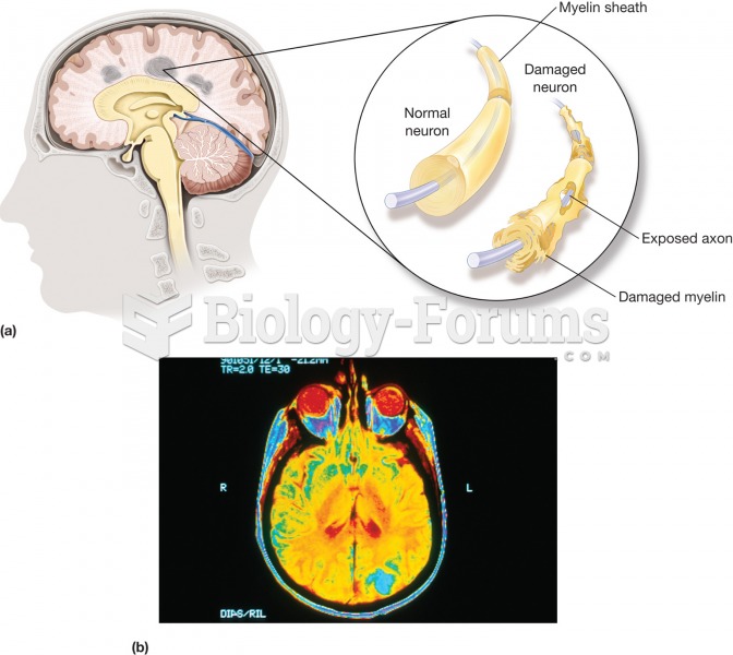 Multiple sclerosis (MS). (a) A disease characterized by the gradual development of small areas of ha