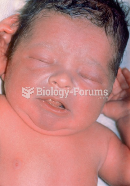 A cyanotic infant. Note the bluish tinge to the skin around the lips, chin, and nose