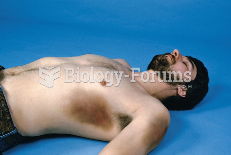 Male lying supine with large ecchymosis on lateral rib cage and shoulder. 