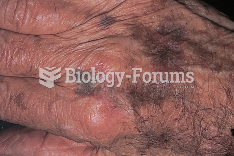 Purpura, hemorrhaging into the skin due to fragile blood vessels. 