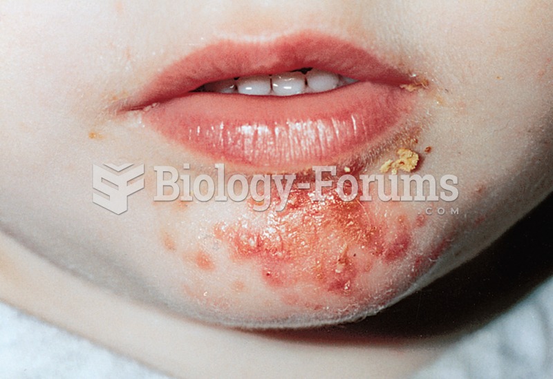 Impetigo, a highly contagious bacterial infection.